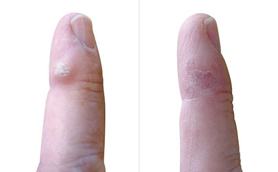 wart removal