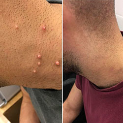 Skin tag