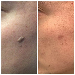 Skin Tags, Moles and Warts removal