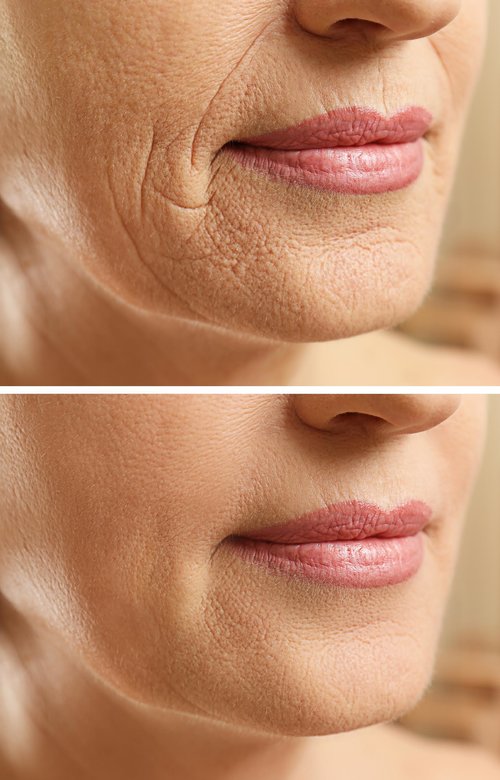 HIFU before and after jowl
