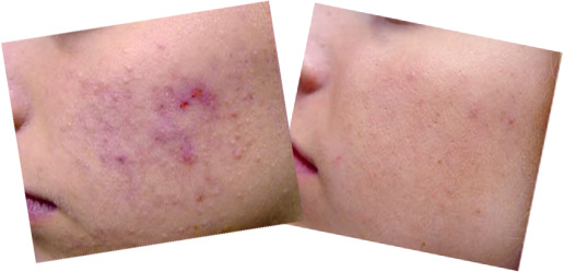 Laser Skin Treatments