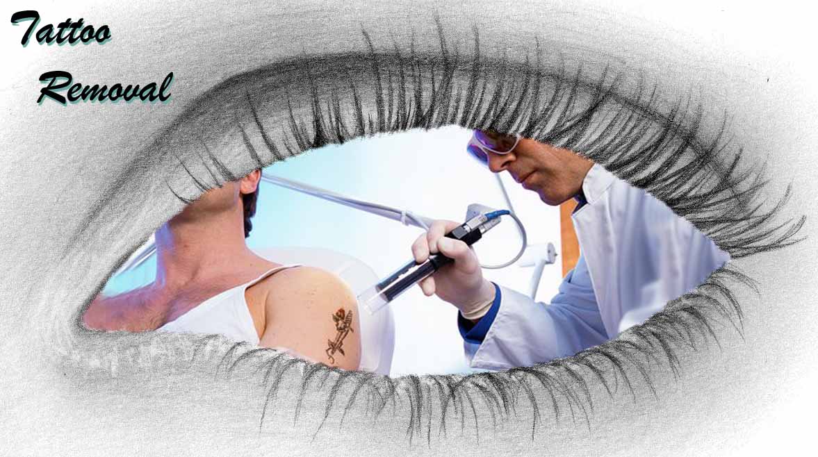 laser tattoo removal at total image salon