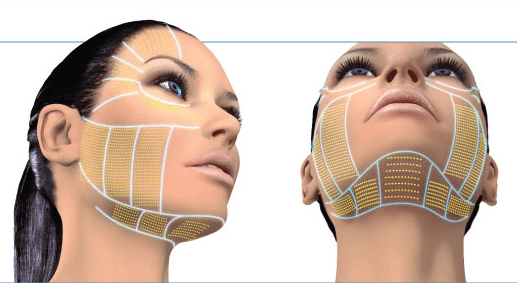 HIFU non-surgical face lifting
