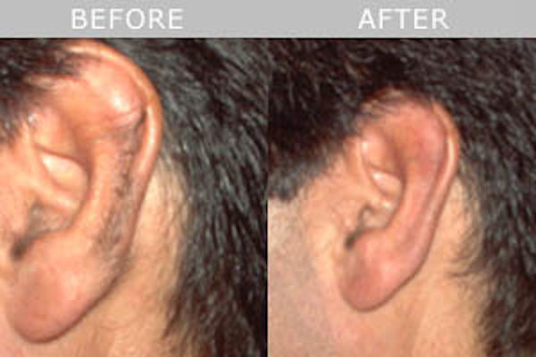 permanent hair removal on ears and nostrils