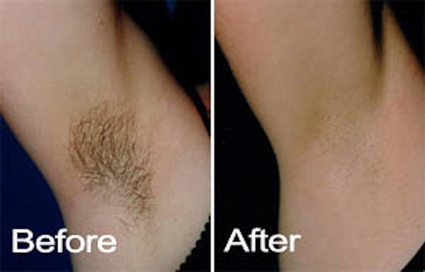 permanent hair removal for woman