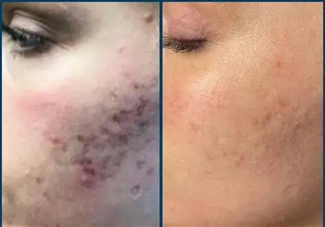 Acne scarring - several treatments required