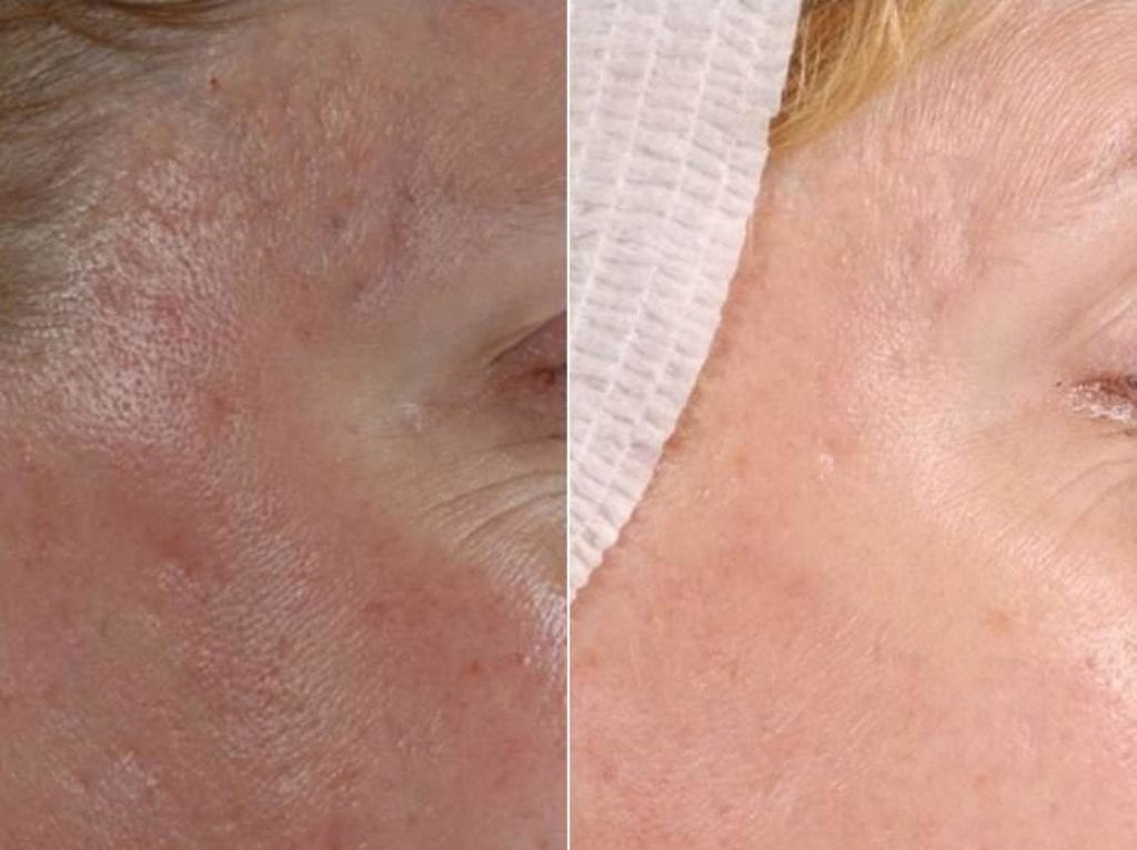 Skin resurfacing after 3 treatments
