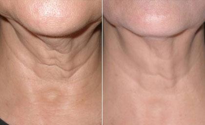 Skin Lifting, Tightening and Tattoo Removal