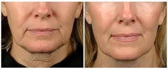 rf-treatment-before-and-after