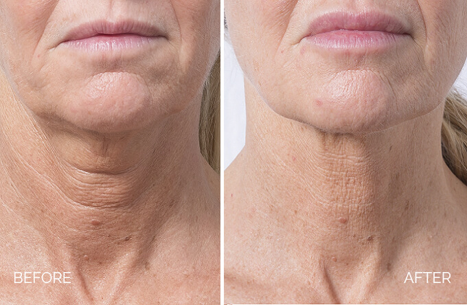 skin-booster-before-after