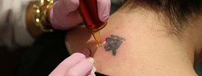 Skin Lifting, Tightening and Tattoo Removal at total image in nottingham