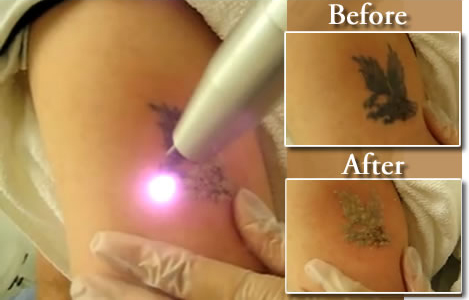 Laser tattoo removal, safest, most effective method
