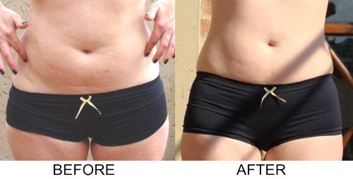 RF treatment before and after